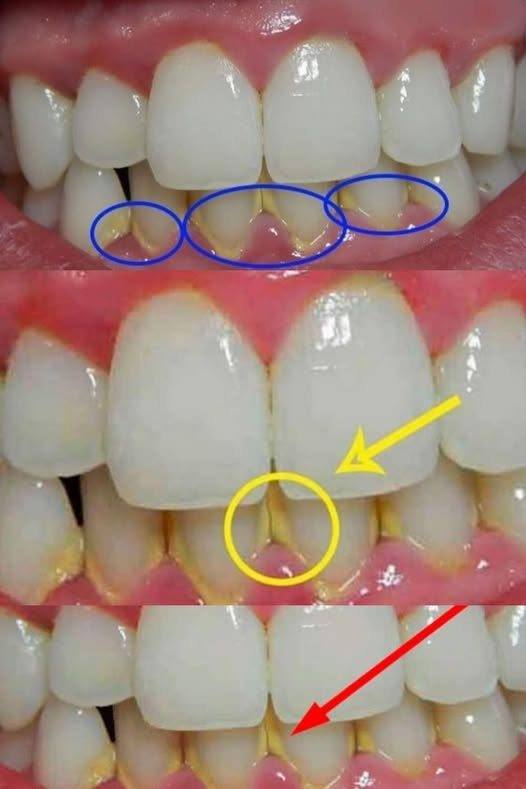 Remove the Dental Plate in 5 minutes Naturally, without Going to the Dentist