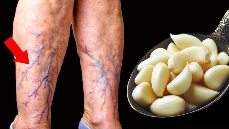 Niewiarygodne! 🤩 Zniszcz żylaki i stany zapalne naturalnie za pomocą czosnku