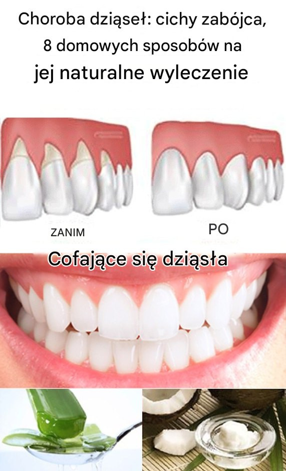 Choroba dziąseł: cichy zabójca – 8 domowych sposobów na jej naturalne wyleczenie